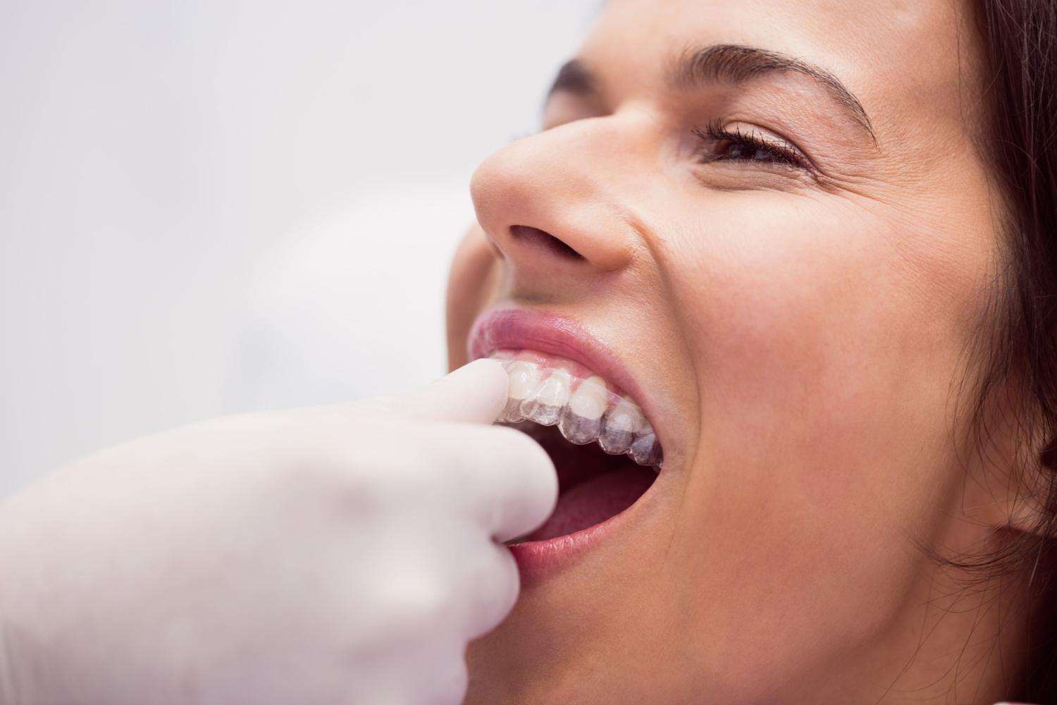 Best Dentist in Indirapuram for Implants, Braces & More