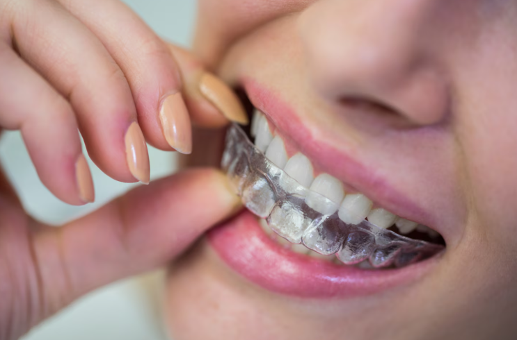 Best Invisible Aligners Indirapuram